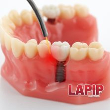 lapip generic image 2